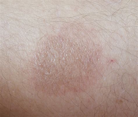 carpet burn knees|Burning in knee: 7 causes and how to treat them .